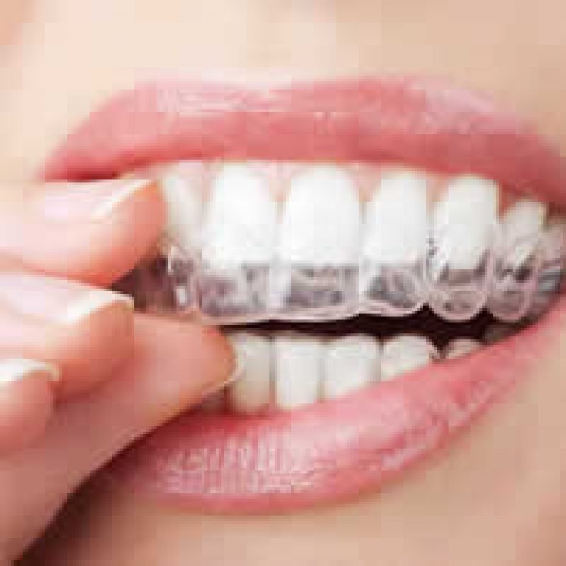 adult bracesRESIZE2